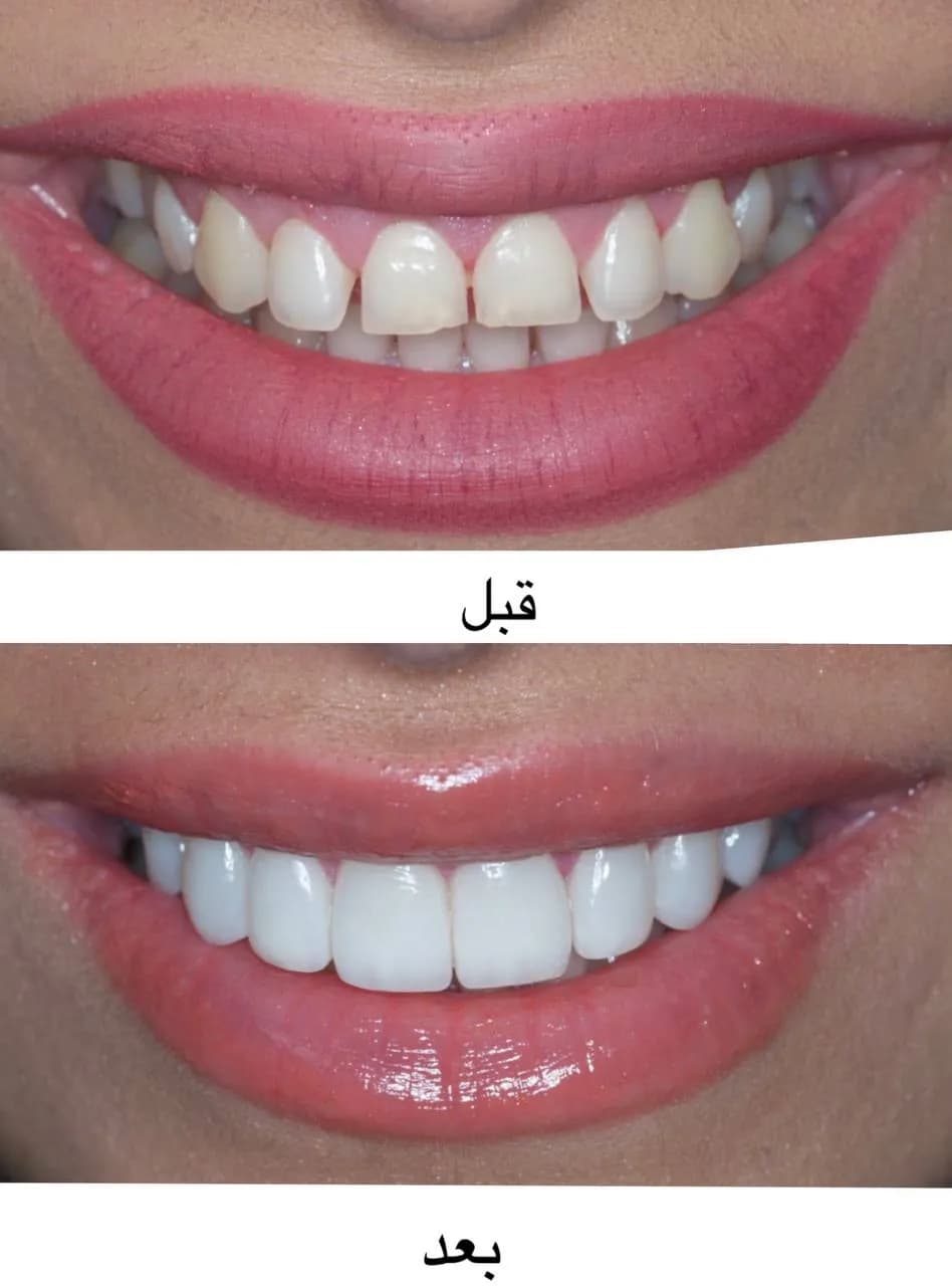 لمینت / کامپوزیت