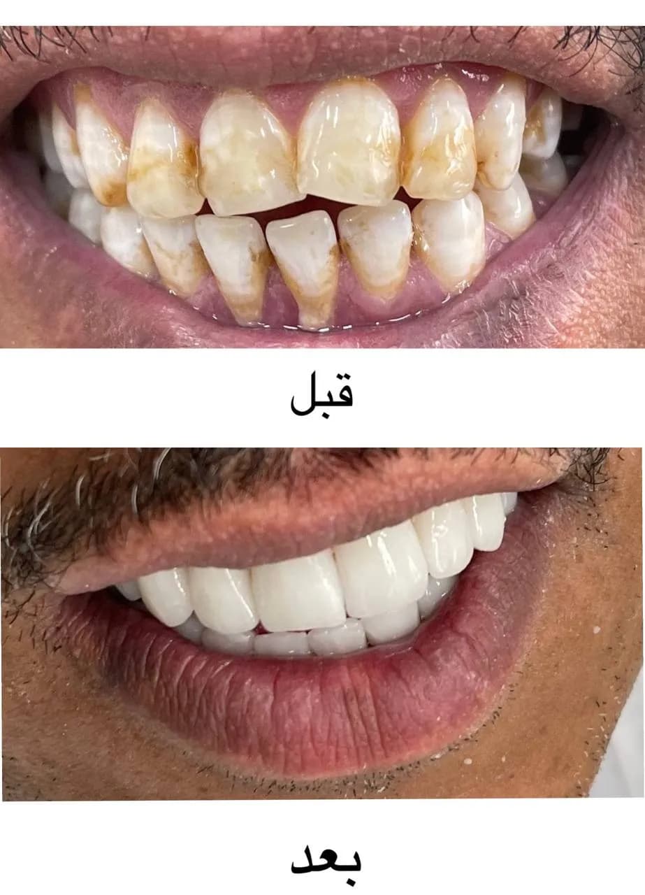 لمینت / کامپوزیت