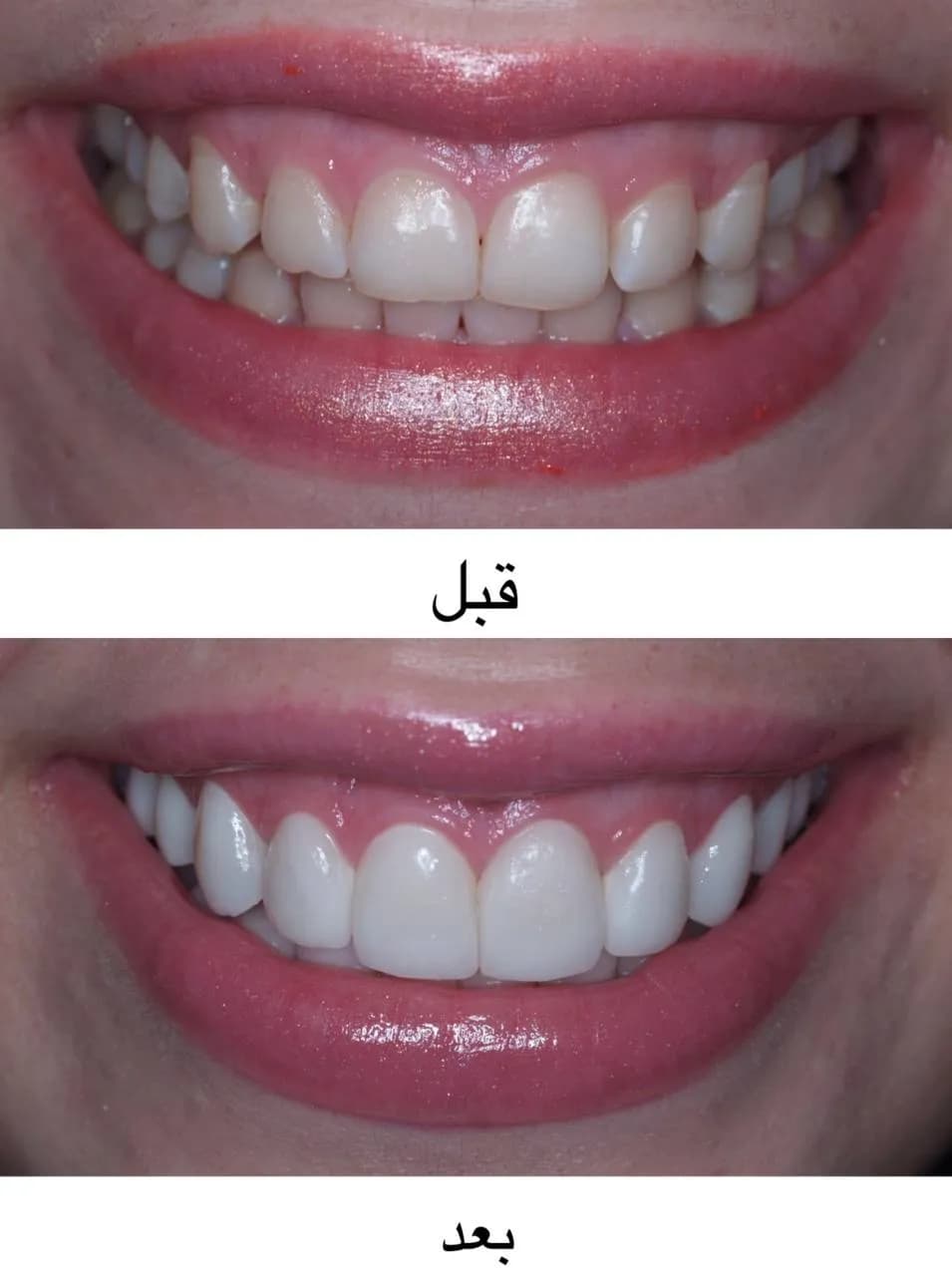 لمینت / کامپوزیت