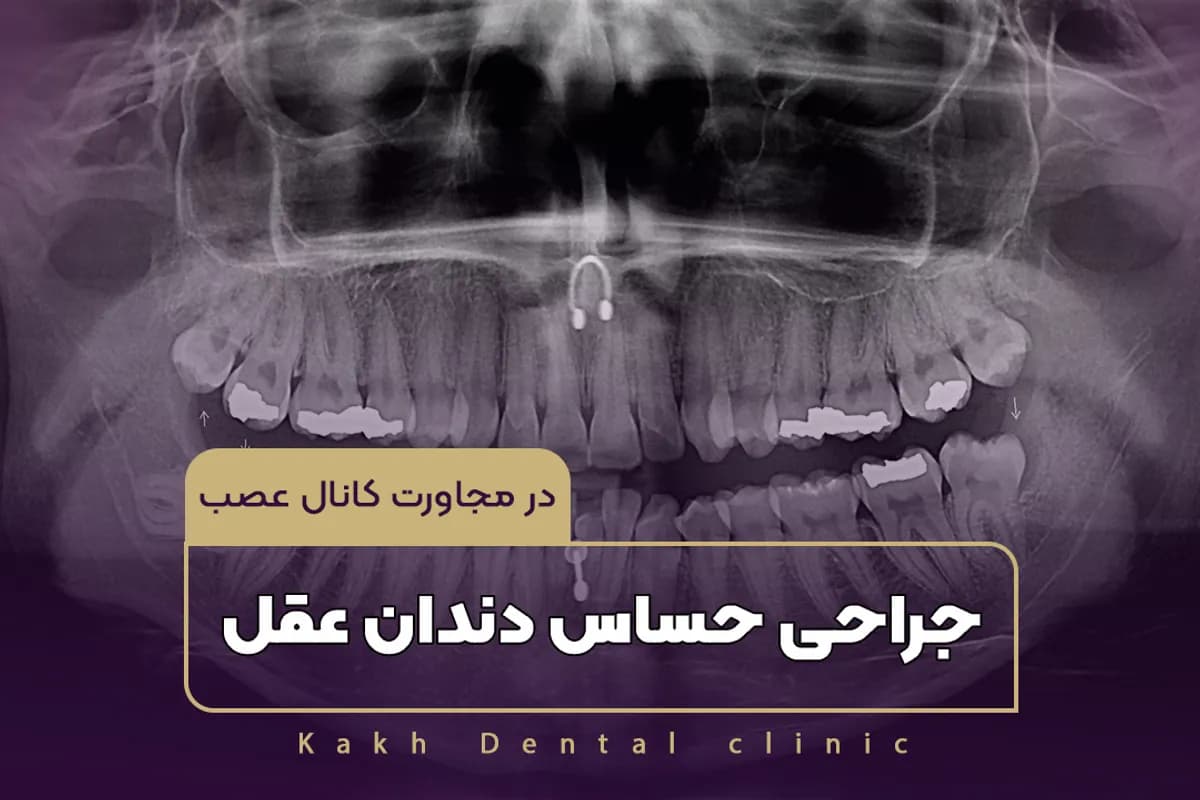 جراحة ضرس العقل الحساسة بالقرب من قناة العصب